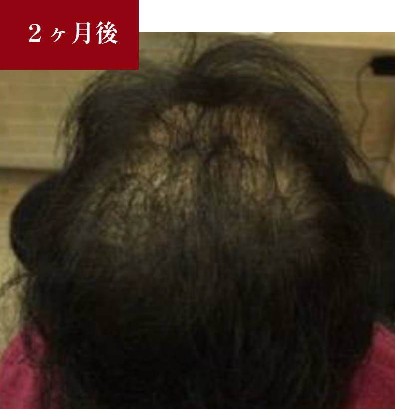 BeforeAfter 2か月後