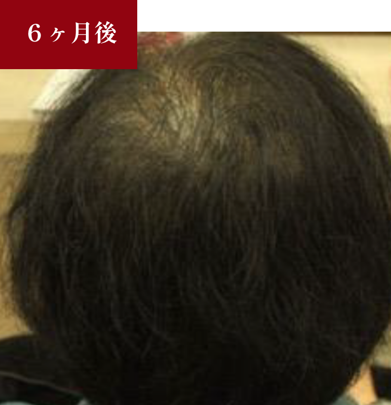 BeforeAfter 6か月後